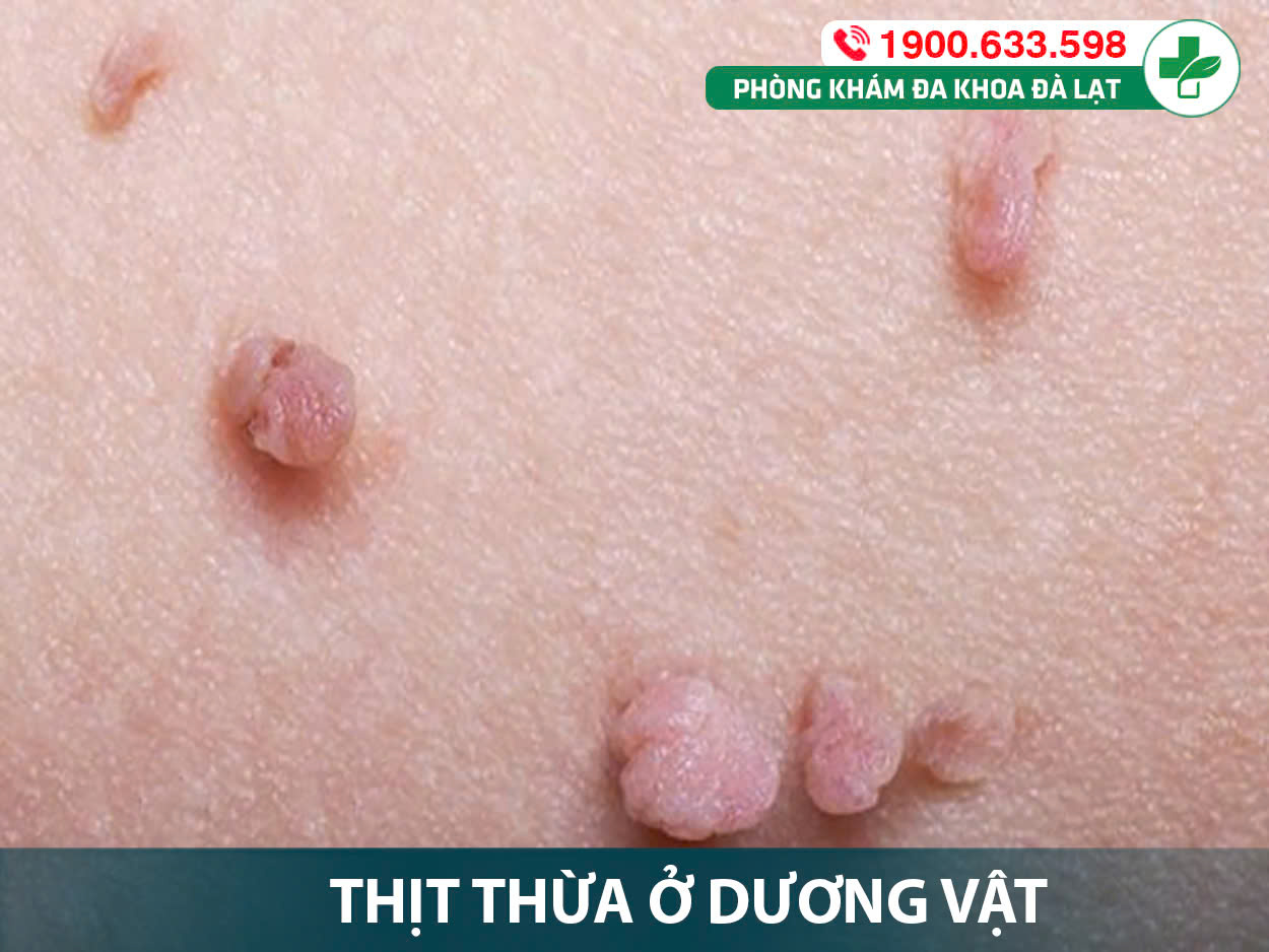Mụn thịt dư ở dương vật có nguy hiểm không?